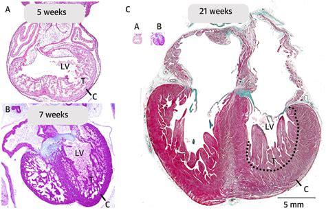 trabeculation of left ventricular myocardium.